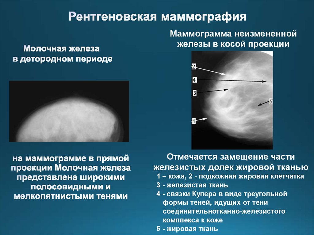 Маммография ответы. Квадранты молочной железы на маммографии. Нормальная рентгеноанатомия молочной железы. Анатомия молочной железы маммография. Рентгенологическая маммография.