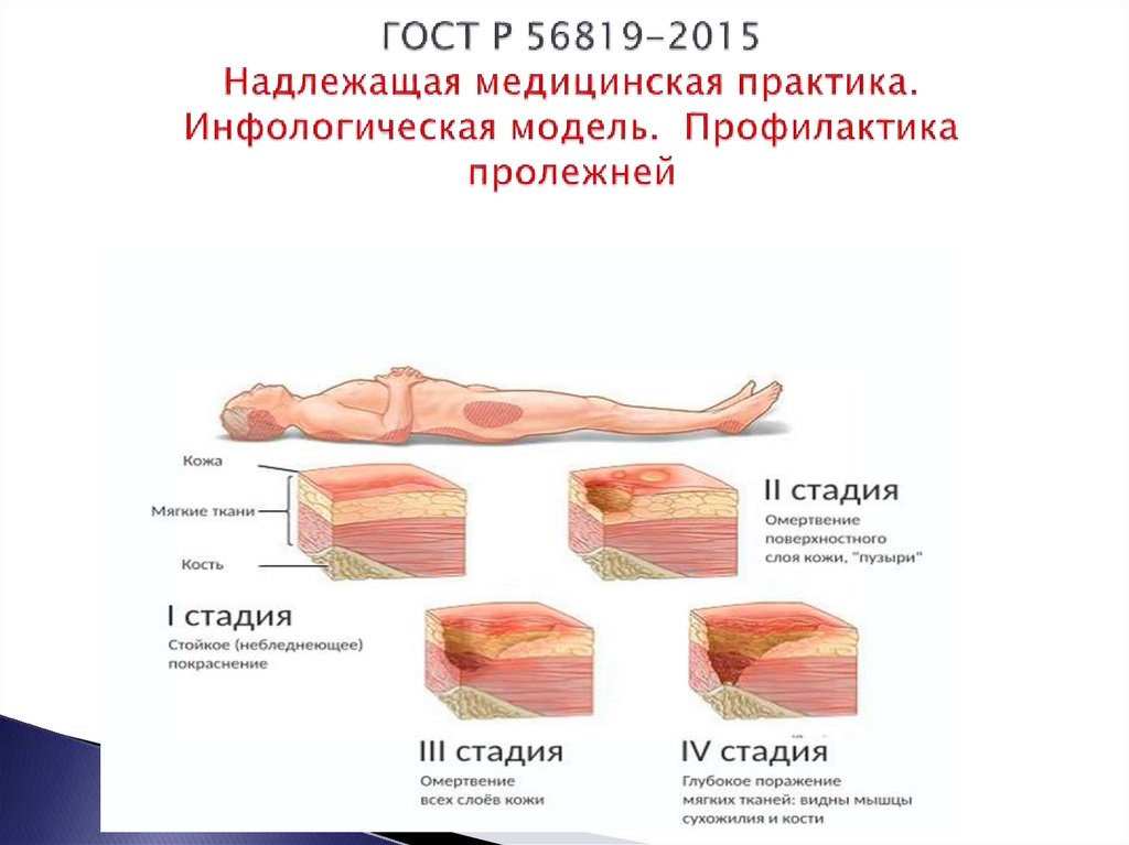 Профилактики возникновения пролежней