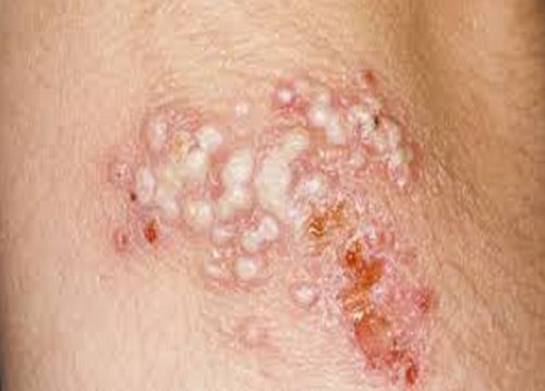 Herpetic Whitlow - Pictures, Symptoms, Contagious, Transmission