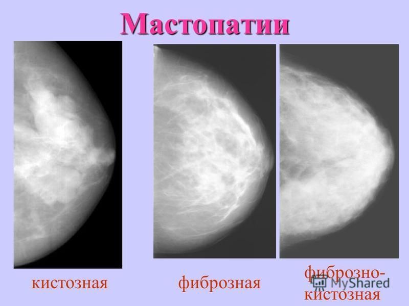 Маммография фкм. Кистозная мастопатия маммография. Фиброзно-кистозная мастопатия маммография. Фиброзная мастопатия на маммографии. Узловая форма ФКМ молочной железы маммография.