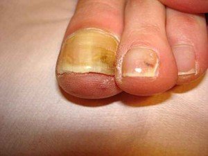 Дерматофиты или грибок ногтей симптомы 1