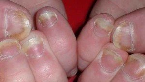 Дерматофиты или грибок ногтей симптомы
