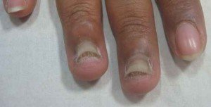 Дерматофиты или грибок ногтей симптомы 4