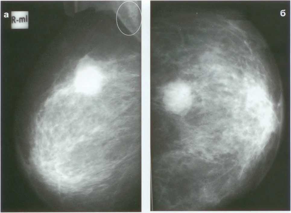 Шишка в грудной железе у женщин. Фибролипома маммография. Фиброаденома молочной железы маммография. Узловая форма ФКМ молочной железы маммография. Маммография фиброаденома.