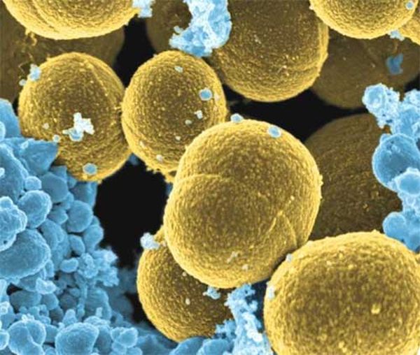 Фото 21 - Фурункул вызывает бактерия золотистого стафилококка