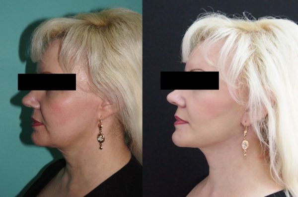 Женщина до и после ирургической подтяжки шеи