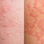 Как выглядит аллергия на коже человека