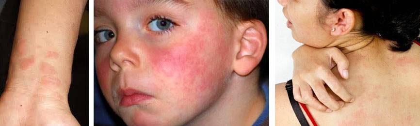 Аллергия на теле, коже рук, лице