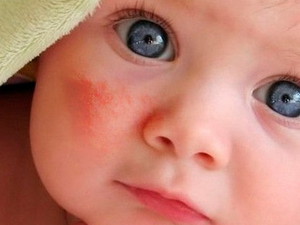 Проявления диатеза у детей на коже
