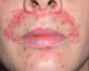 Экзема - острое или хроническое незаразное воспалительное заболевание кожи