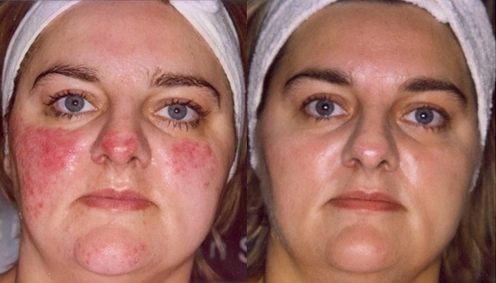 До и после лечения купероза