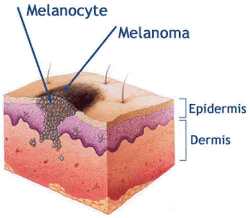 Стадии образования меланомы