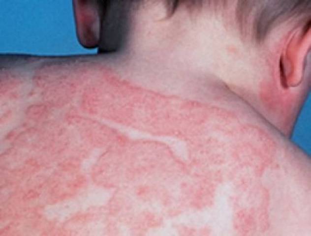 Антигистаминные средства чаще всего используют для лечения кожной аллергии