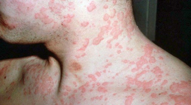 Для устранения симптомов кожной аллергии применяют различные медикаментозные препараты