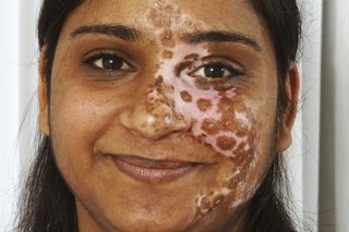 Picture of a woman with segmental vitiligo affecting the face