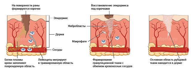 Процесс формирования рубцовой ткани