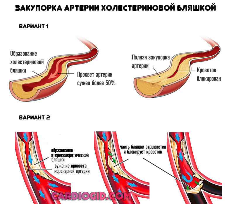 закупорка-коронарной-артерии-холестериновой-бляшкой