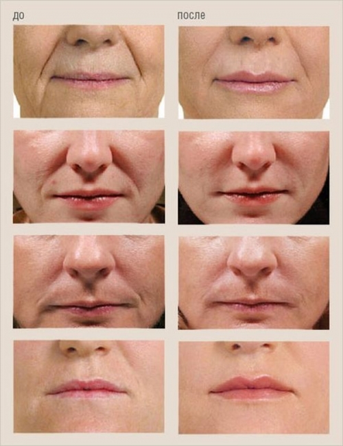 Гиалуроновая кислота для лица уколы эффект до и после фото