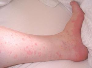 Аллергические высыпания на ноге на нервной почве