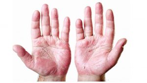 Что делать, если кожа на пальцах рук шелушится причины и лечение