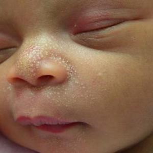 что за белые точки на носу у новорожденного