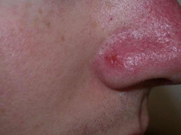 рак кожи на носу