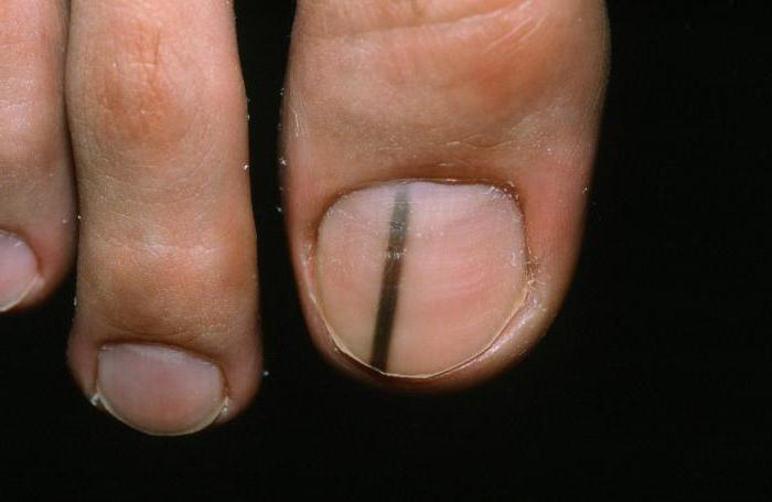 Меланома ногтя