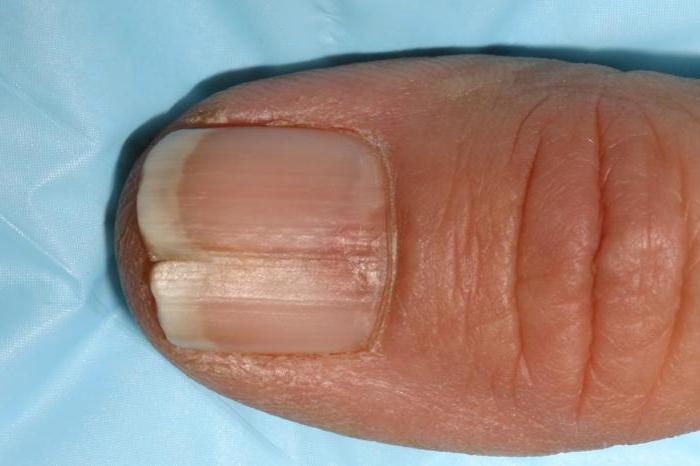 Меланома ногтя начальная стадия