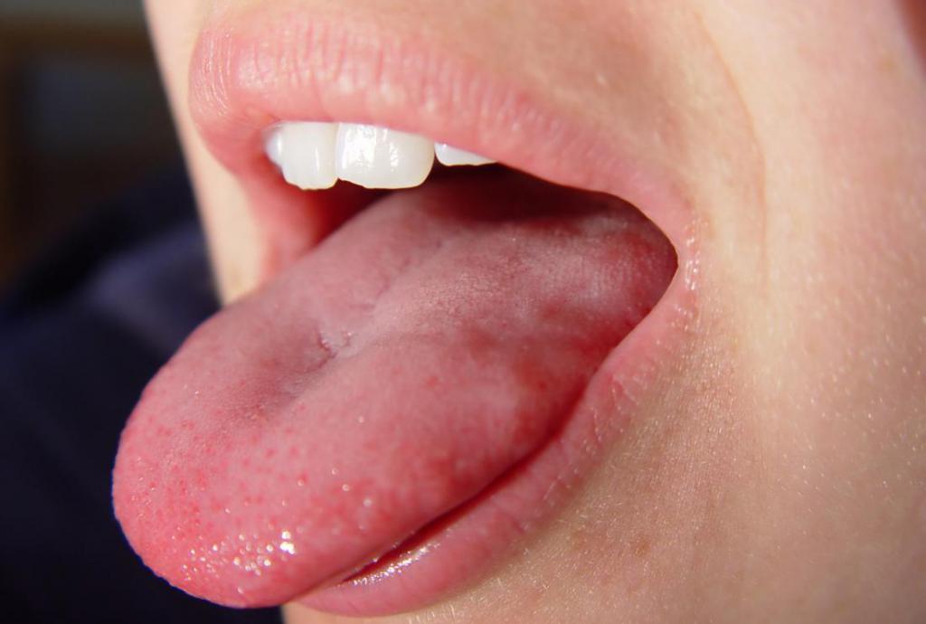папилломы под языком лечение