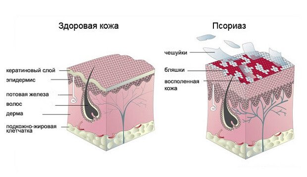 Псориаз