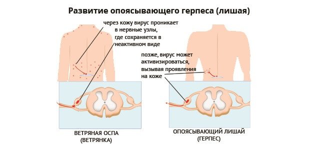 Опоясывающий лишай