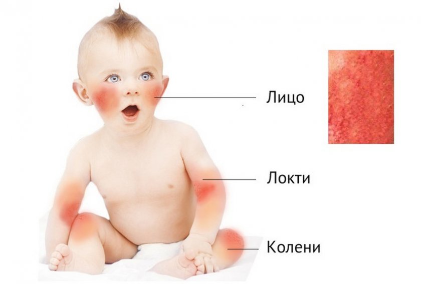 Диатез у детей