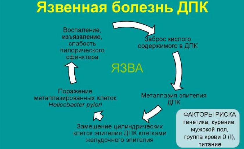 Заболевание двенадцатиперстной кишки