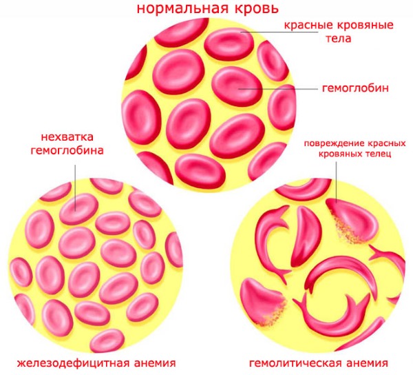 Низкий гемоглобин у женщин: причины, симптомы и последствия. Лечение пониженного уровня гемоглобина