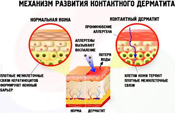 Шелушится и краснеет кожа лица. Причины и признаки заболеваний, лечение