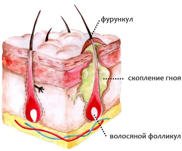 Фурункулез. Лечение препаратами, народными средствами, гомеопатией, переливанием крови