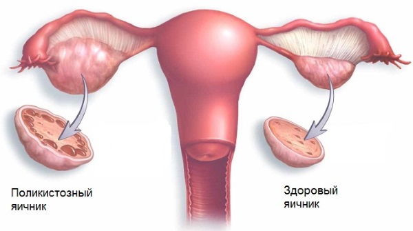 Фурункулез. Лечение препаратами, народными средствами, гомеопатией, переливанием крови