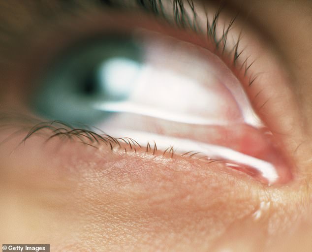 Did you know? Dry eyes are typically the result of a problem with the meibomian glands in the upper and lower eyelids