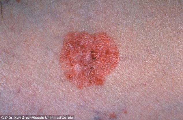 A squamous cell carcinoma, pictured here, may look scaly, have a hard, crusty cap and feel tender to touch
