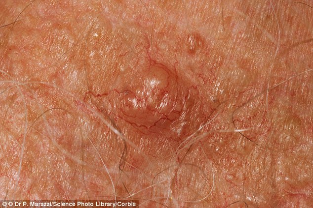 A basal cell carcinoma, pictured here, may be smooth and pearly, look waxy, be itchy and sometimes bleed