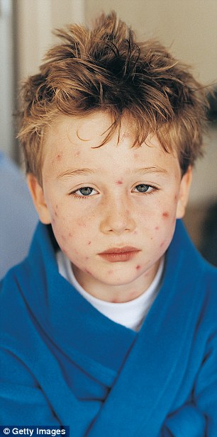 More than 90 per cent of children now receive vaccinations against chickenpox (stock image)