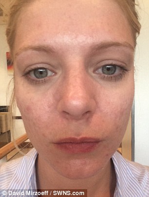 In May she went to the clinic for her first consultation about getting a chemical peel to freshen up her face and was advised that a C02 laser treatment would be best