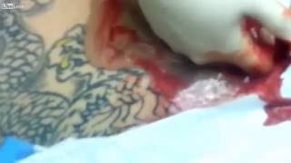 Воспалившаяся татуировка