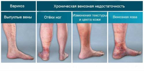 Стадии варикозной болезни ног