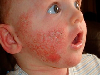 Проявления крапивницы на лице у ребенка
