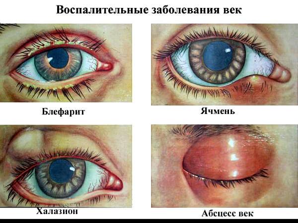 Воспалительные болезни глаз