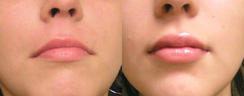 Восстановление после увеличения губ гиалуроновой кислотой: фото