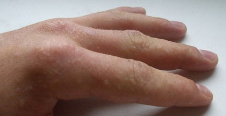 При каких болезнях появляются пузырьки под кожей на пальцах рук