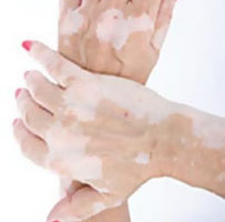 Аутоиммунное заболевание, при котором на коже рук появляются белые пятна.