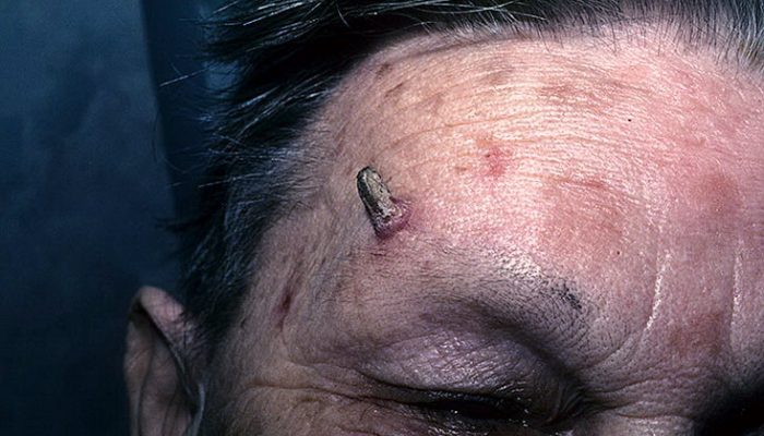 Что такое кожный рог у человека? Причины и эффективные методы лечения